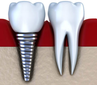 implantodontia-tratamentos-odontologia-carneiro