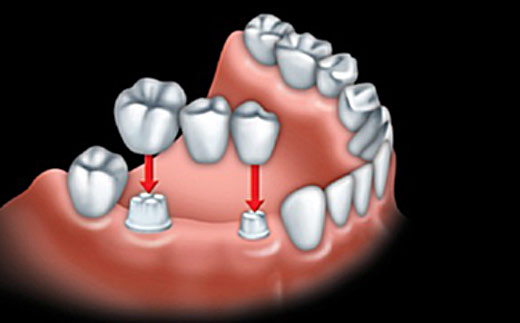 Odontologia Carneiro Próteses