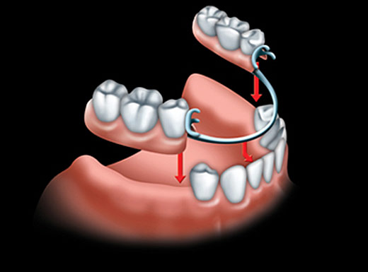 protese-parcial-removivel-ppr-odontologia-carneiro