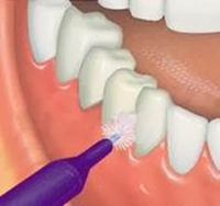 escova-interdental-dicas-e-duvidas